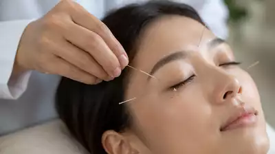 User engaging in acupuncture for eye health