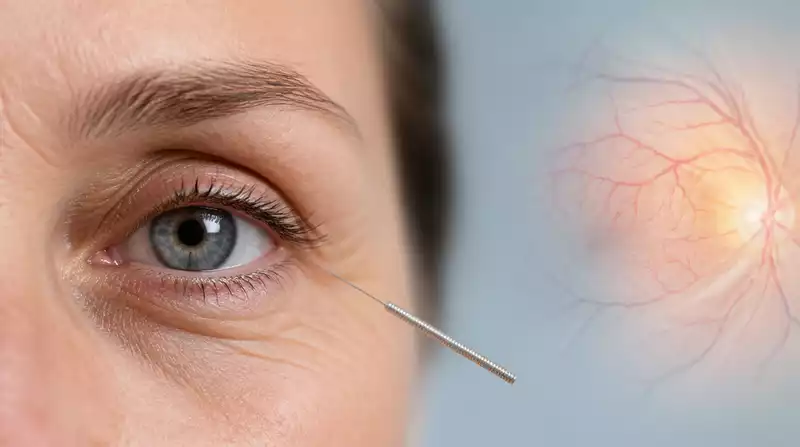Augenakupunktur und diabetische Retinopathie